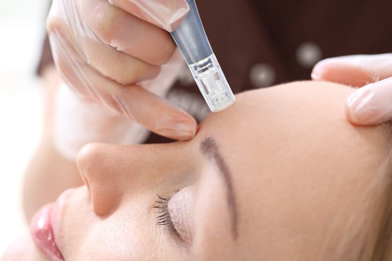 Performing microneedling on a women's face in Boca Raton, FL and Palm Beach County, FL.