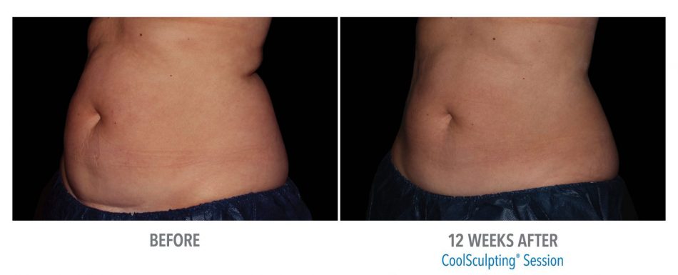 before and after fat freezing on abdomen
