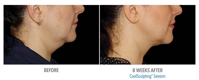 coolsculpting before and after on chin in boca raton