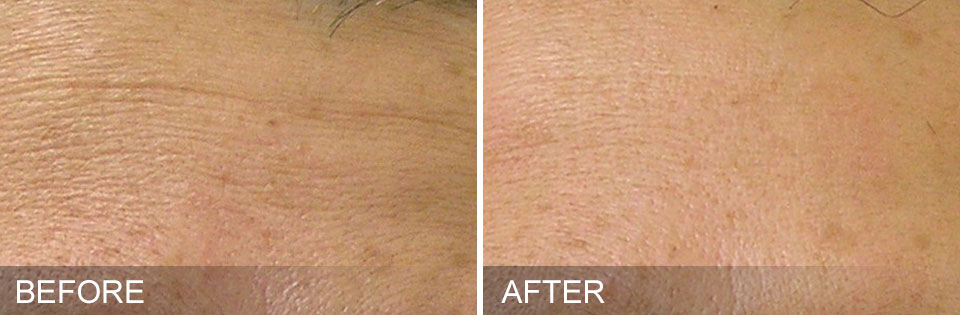 coolsculpting before and after on stomach in boca raton, florida